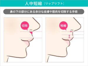 人中短縮とは