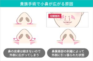 貴族手術で小鼻が広がる原因