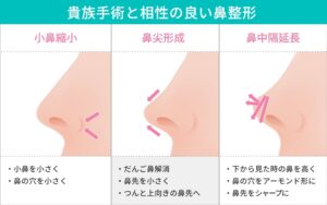 貴族手術と相性の良い鼻整形