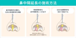 鼻中隔延長の施術方法