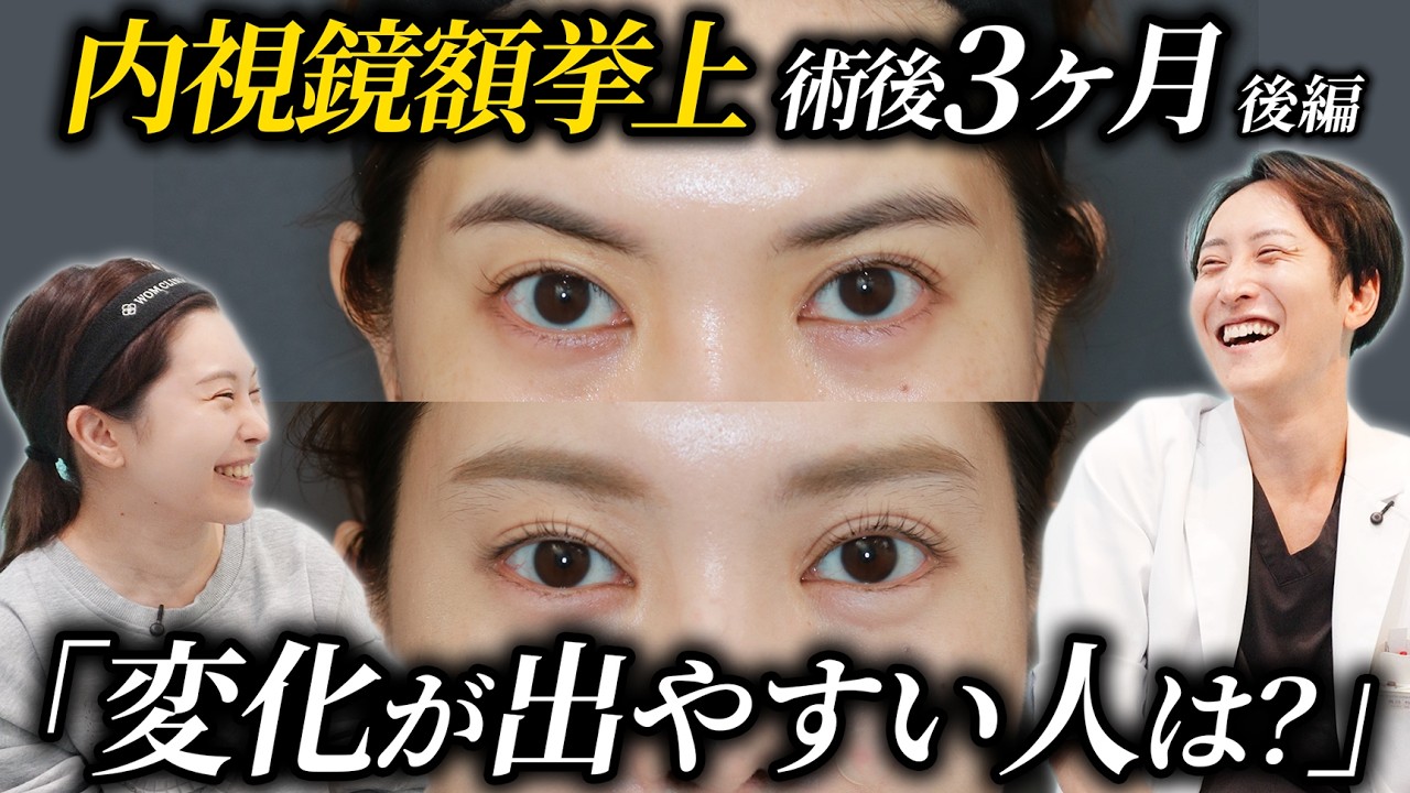 【質問攻め】受けたから分かる内視鏡額挙上のアレコレ【後編】