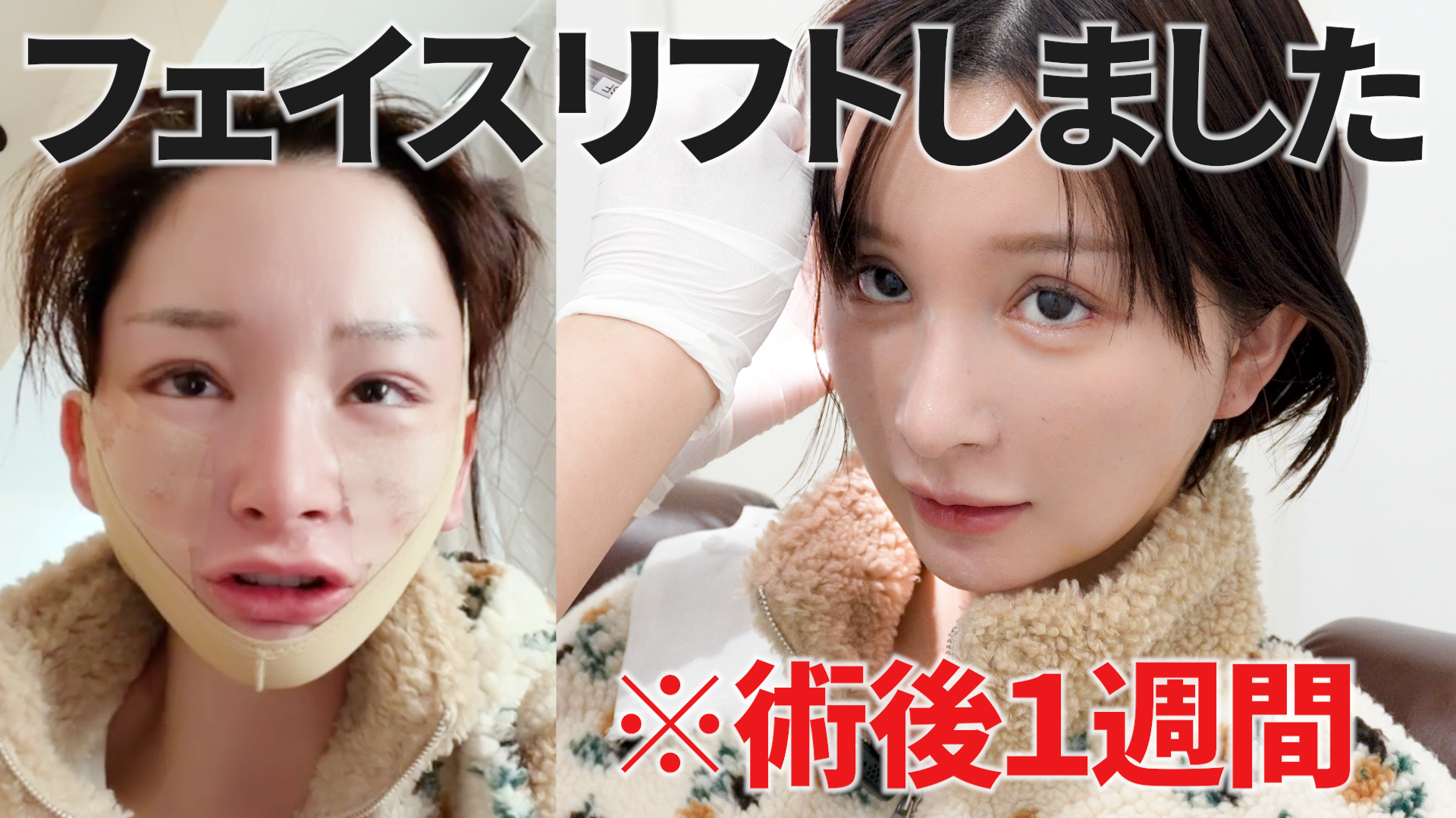  たるみとほうれい線をポニーテールリフトで撃退します【ダウンタイム1ヶ月】