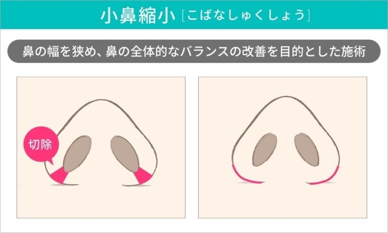 小鼻縮小術前後の鼻のイラスト
