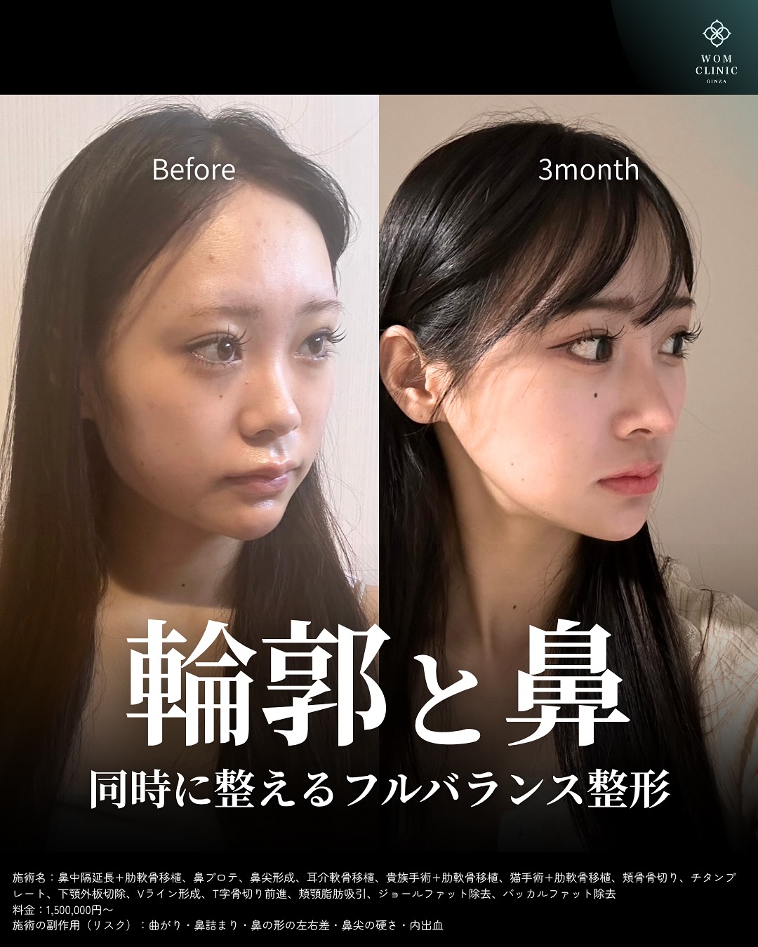 鼻フル整形の術前と3ヶ月後のビフォーアフター