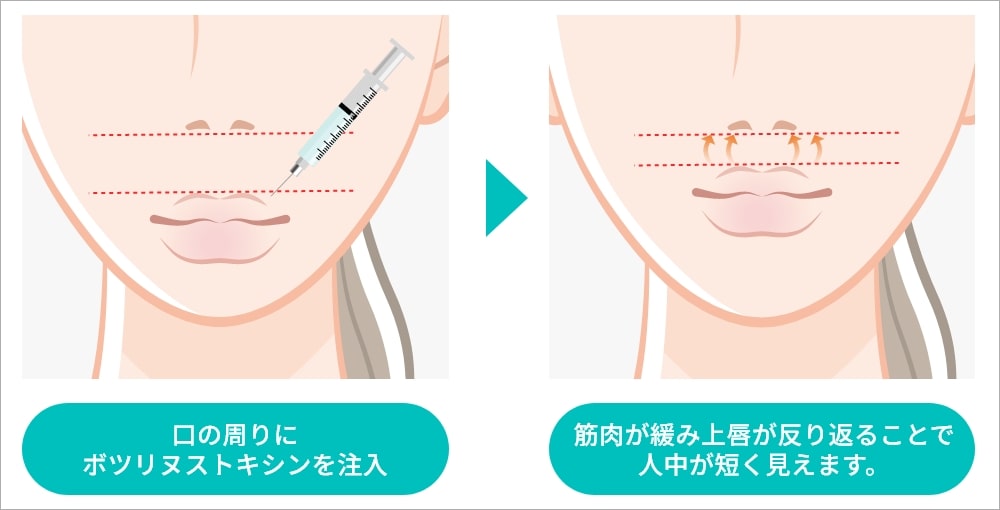 ボトックス注射