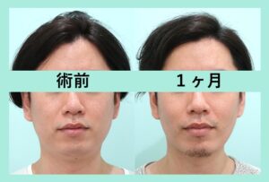 男性の脂肪吸引　症例写真2