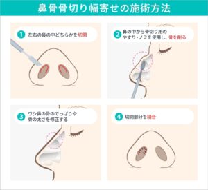 鼻骨骨切り幅寄せの施術方法