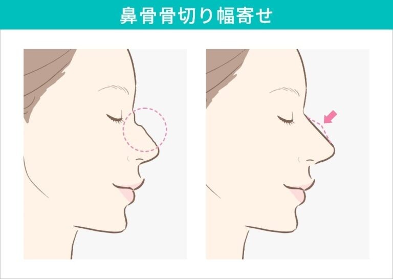 鼻骨骨切り幅寄せの術前術後の比較