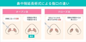 鼻中隔延長術式による傷口の違い