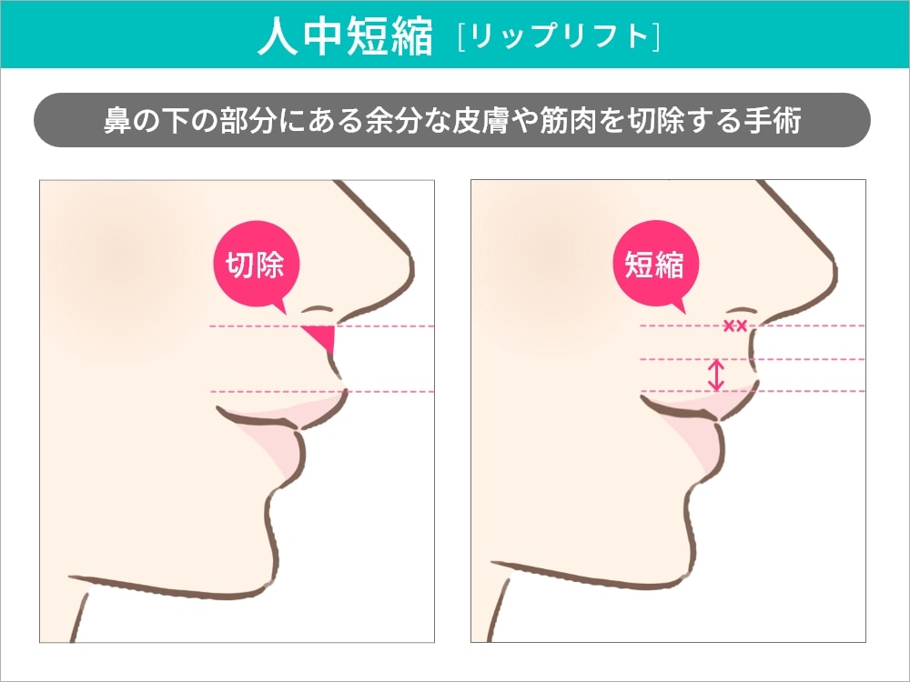 人中短縮