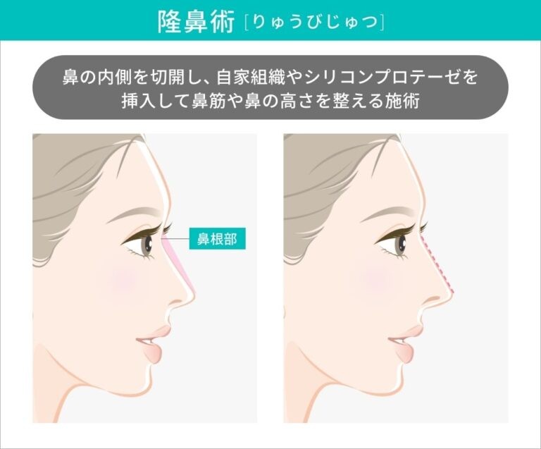 隆鼻術の術前と術後の鼻の比較