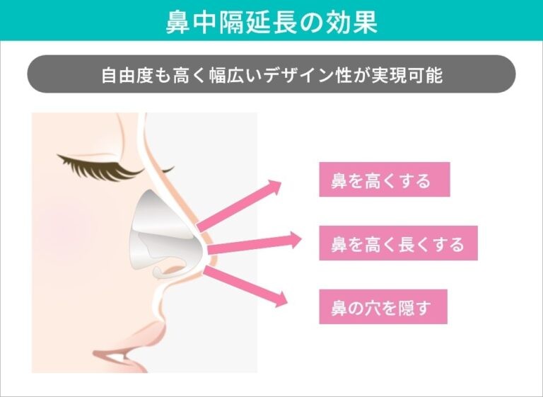 鼻中隔延長術の効果イメージ図