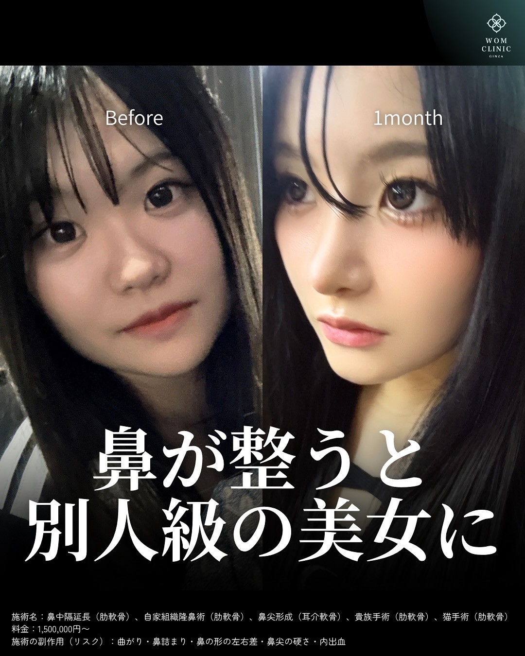 似合わせ鼻の術前と1ヶ月後のビフォーアフター