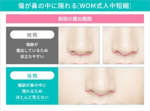 人中短縮の比較
