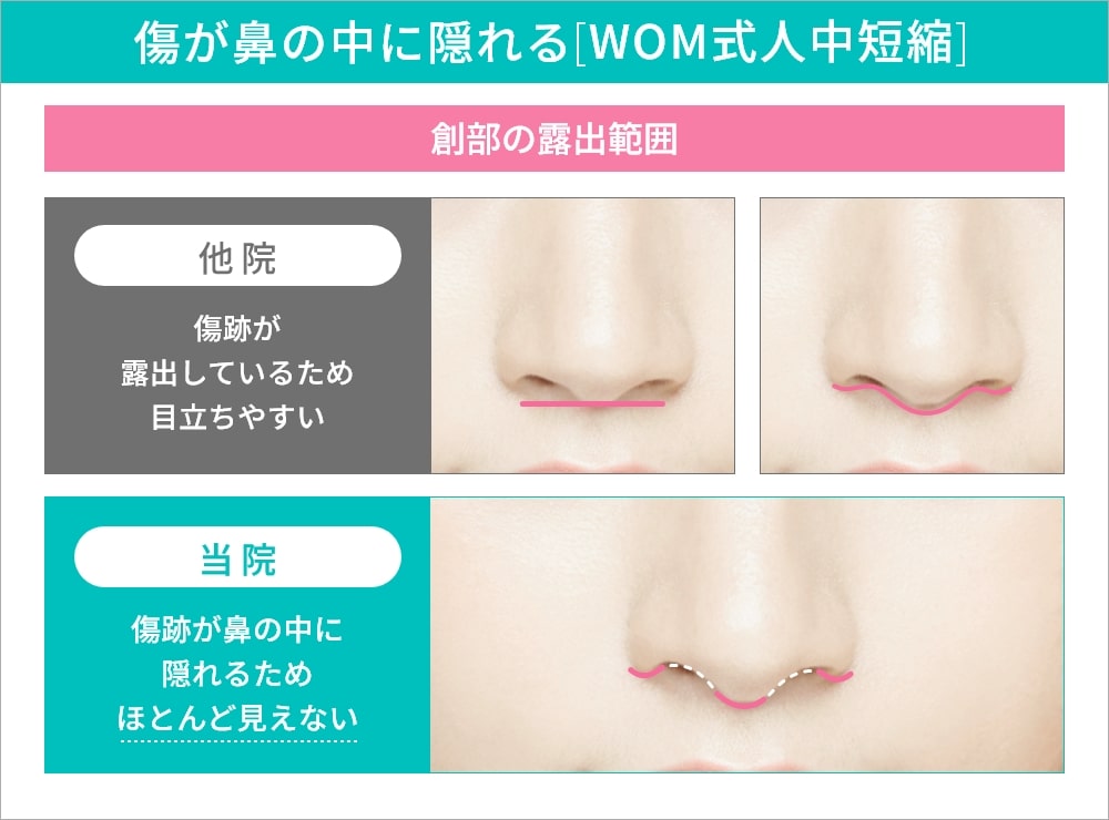 人中短縮の比較