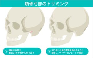 頬骨弓トリミング