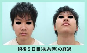 頬骨削りのダウンタイムの症例写真