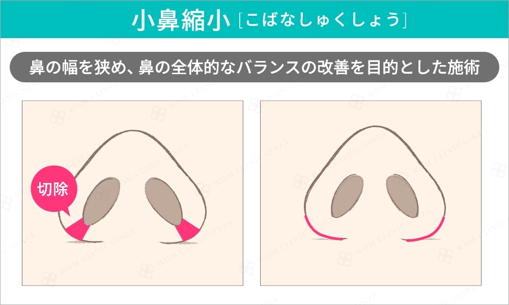 小鼻縮小