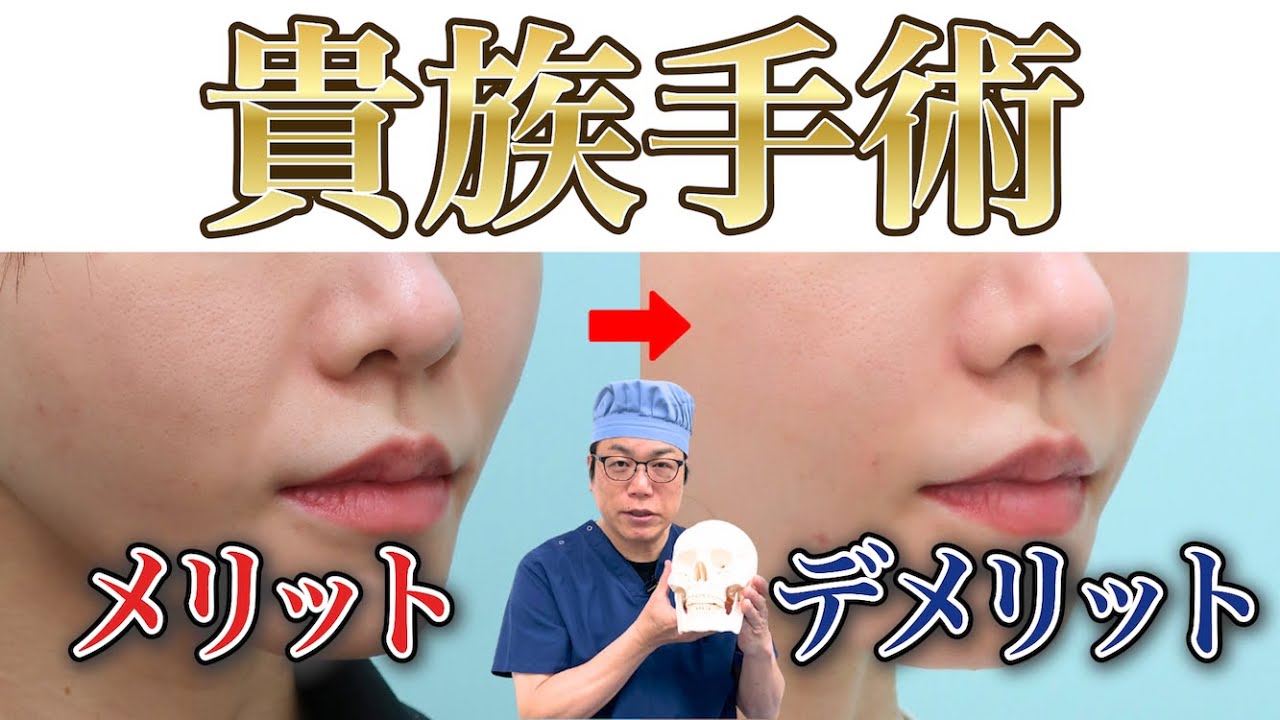 【失敗回避】貴族手術（鼻翼基部形成）のメリットデメリットをベテランDrが解説!!