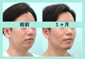 ほほ・あごの脂肪吸引の症例写真　斜め方向