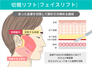 切開リフト