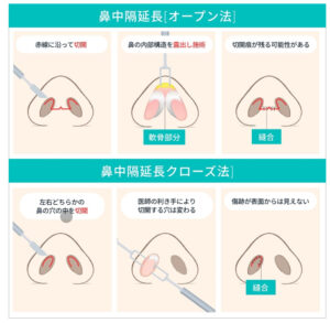 鼻中隔延長（オープン法・クローズ法）