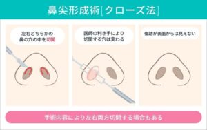 鼻尖形成　クローズ法