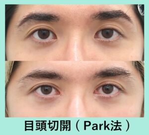 目頭切開Park法の症例