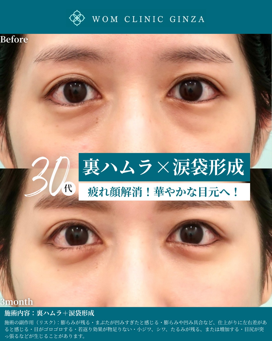 裏ハムラ法と涙袋形成のビフォーアフター(30代)