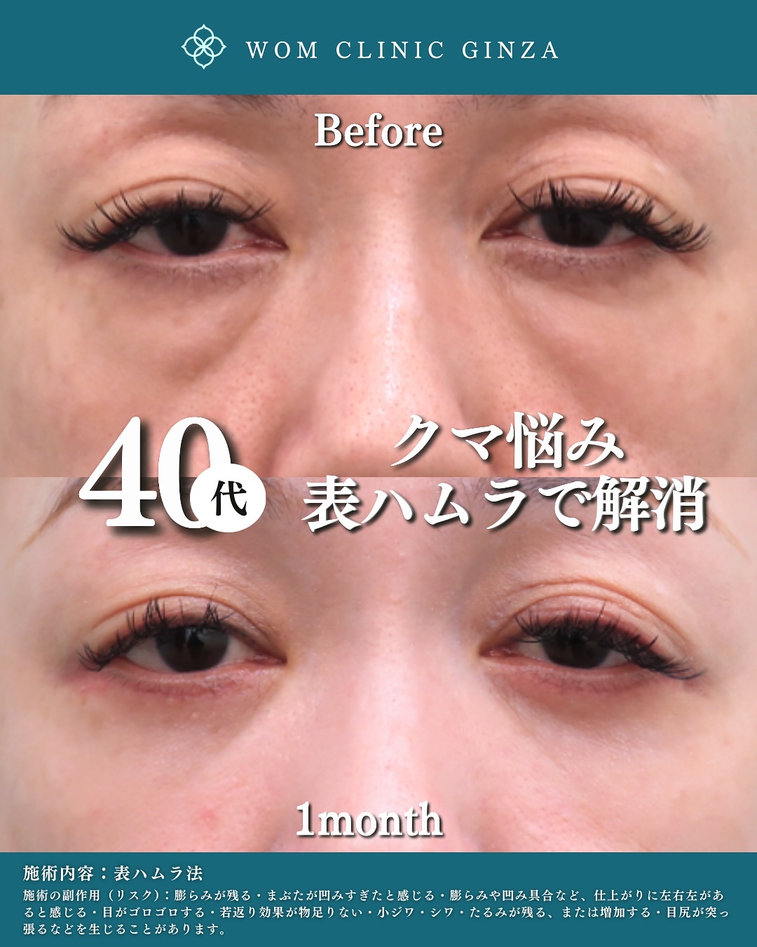 表ハムラ法のビフォーアフター(40代)