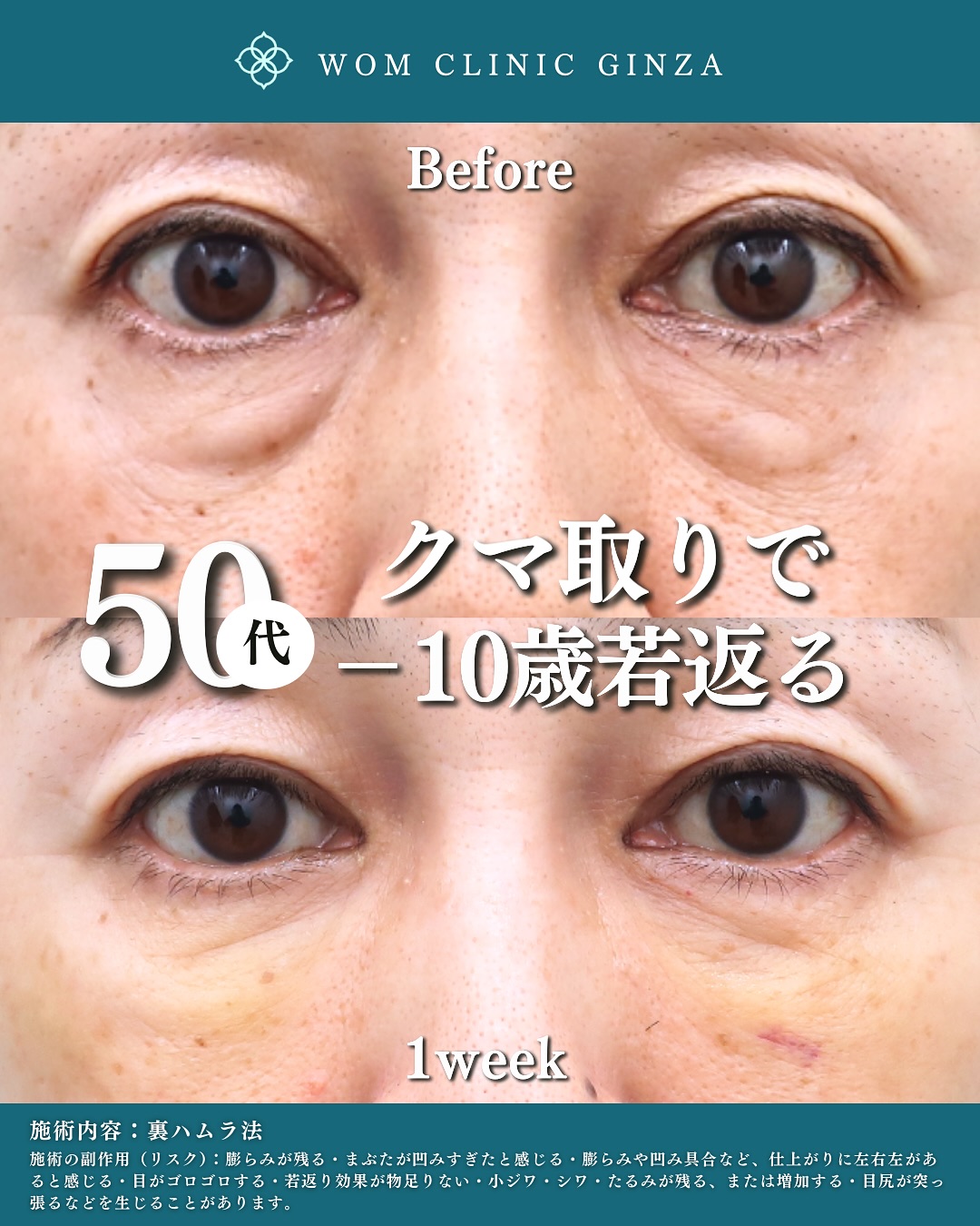 裏ハムラ法のビフォーアフター(50代)