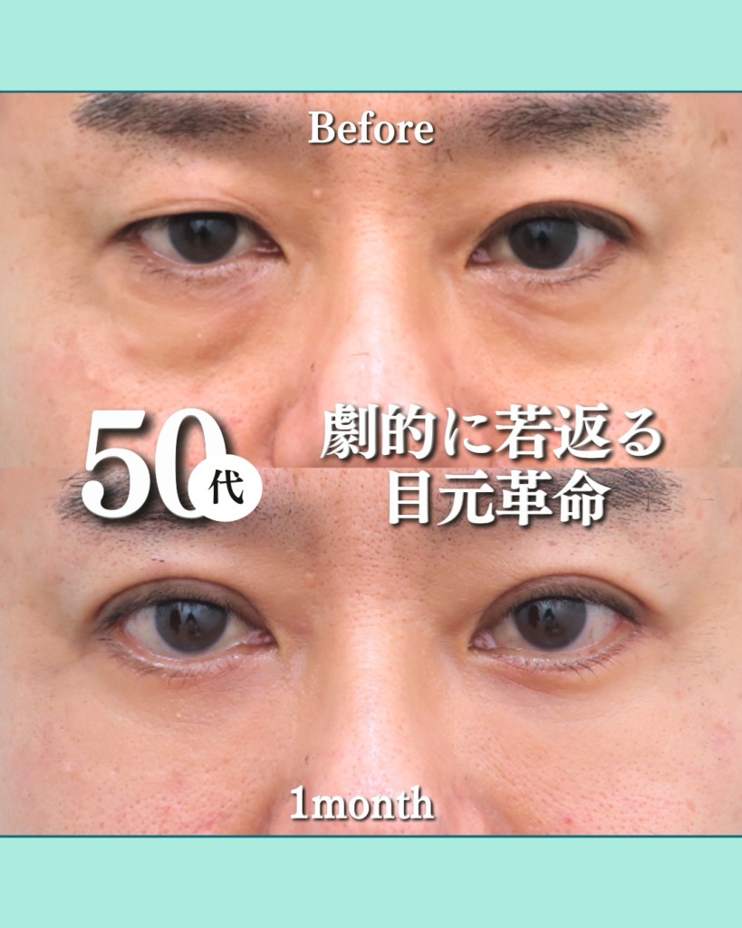 表ハムラ法＋二重埋没法の症例