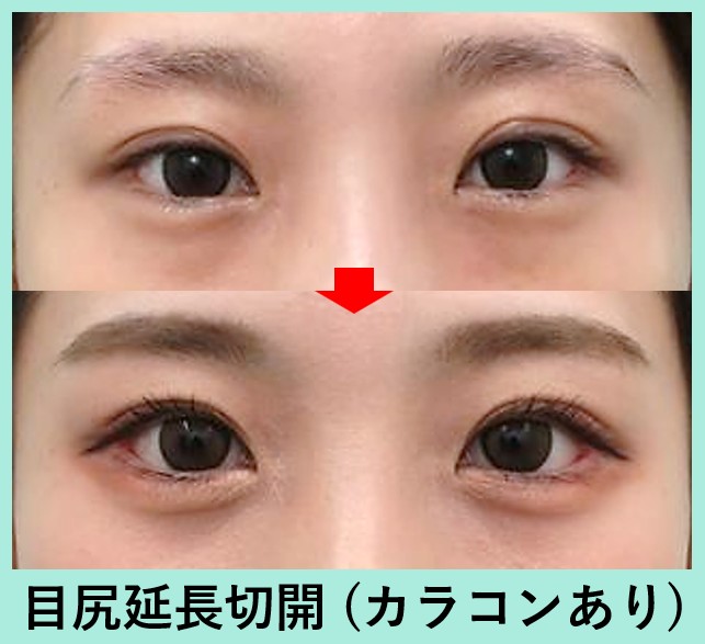 目尻切開の症例写真