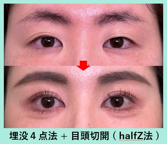 二重埋没法の症例写真