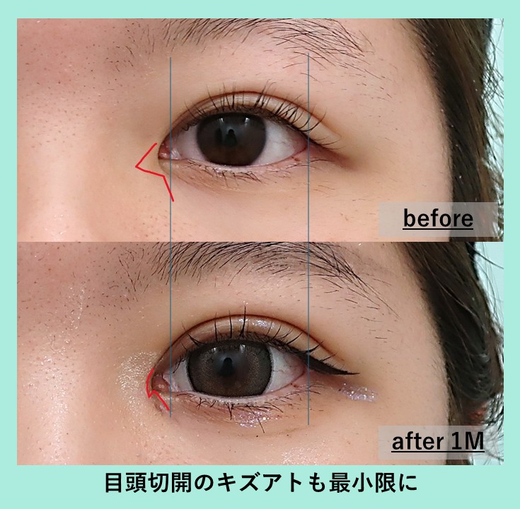 目頭切開の症例写真