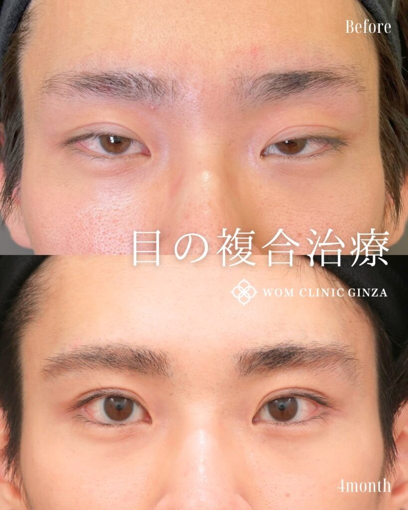 眼瞼下垂手術の症例写真