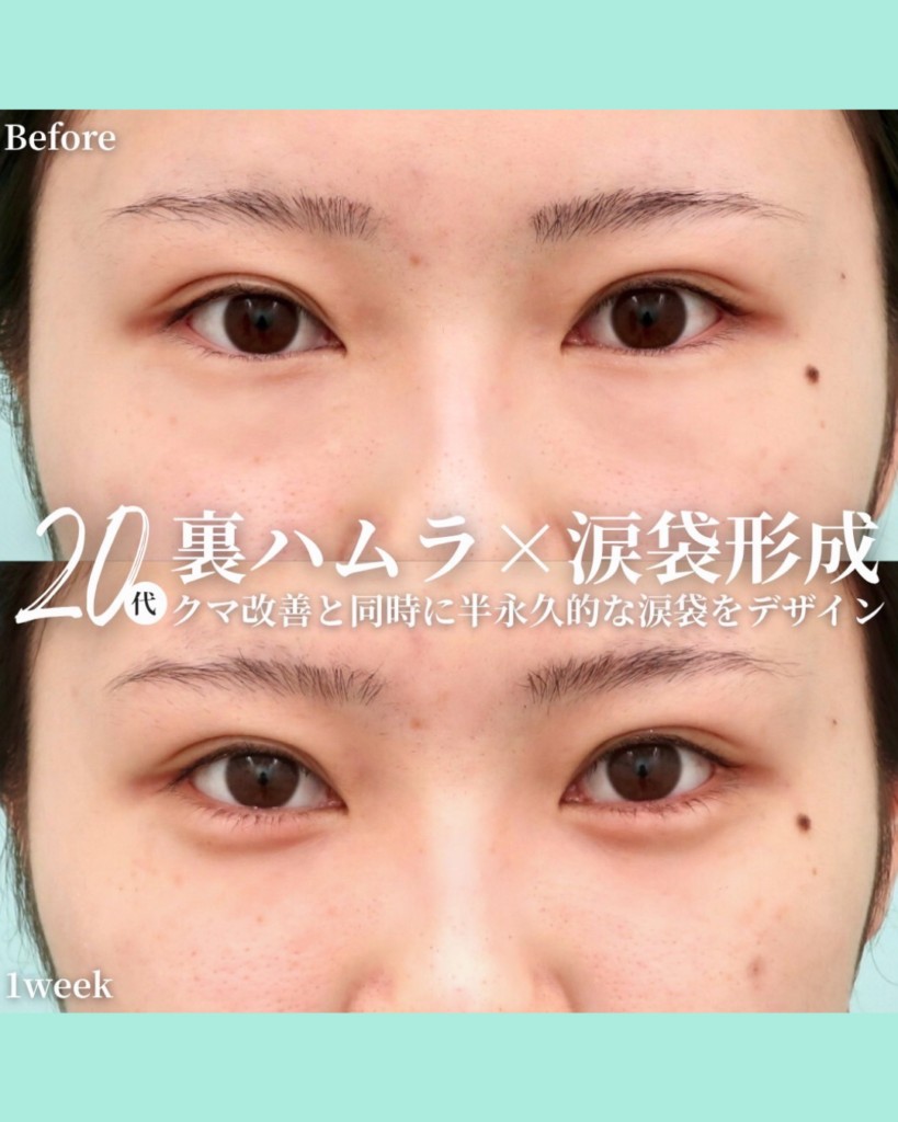 涙袋形成の症例写真