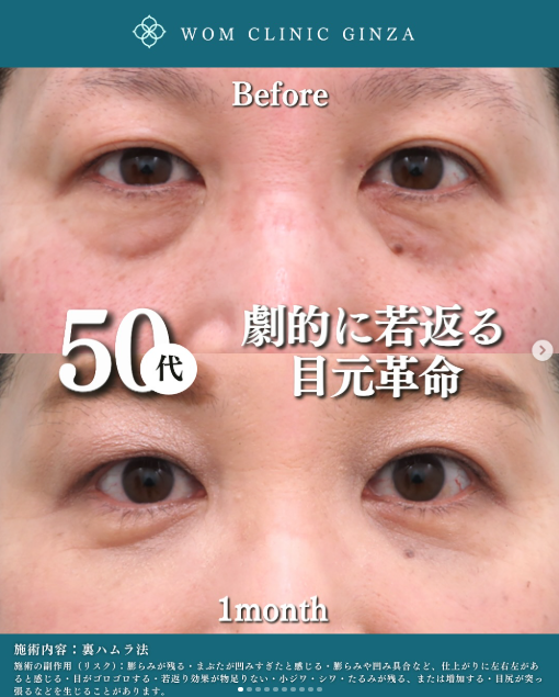 裏ハムラ法の症例