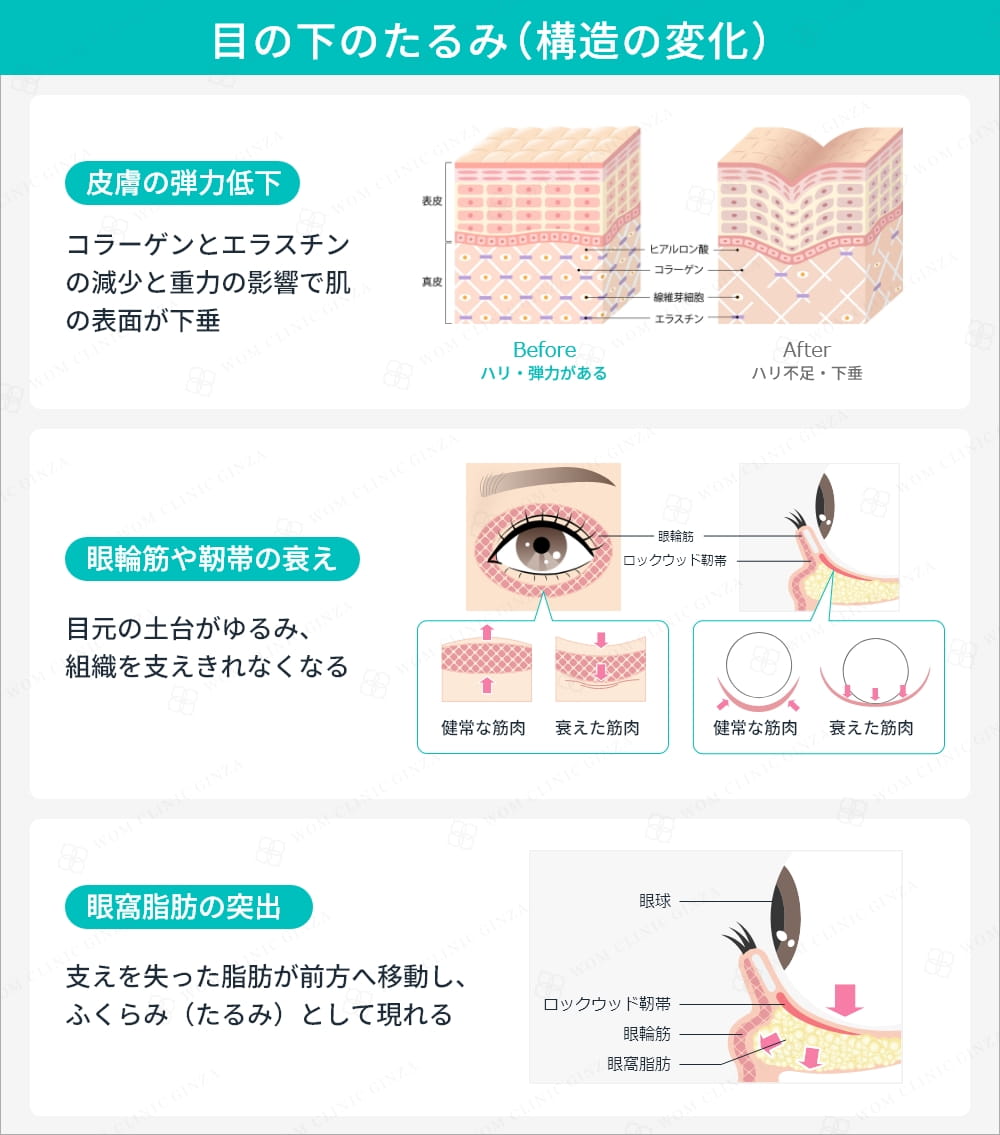 目の下のたるみタイプと構造の変化