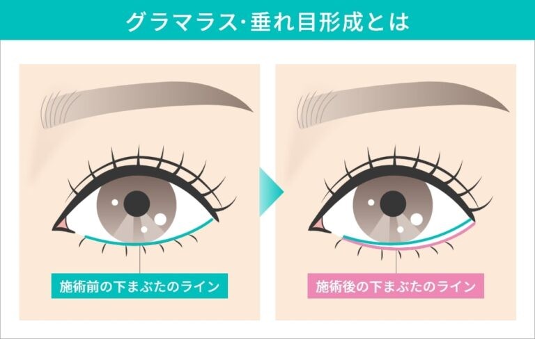 グラマラス形成