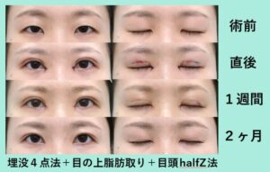 二重埋没法+脂肪取り+目頭切開（Z法）の症例写真