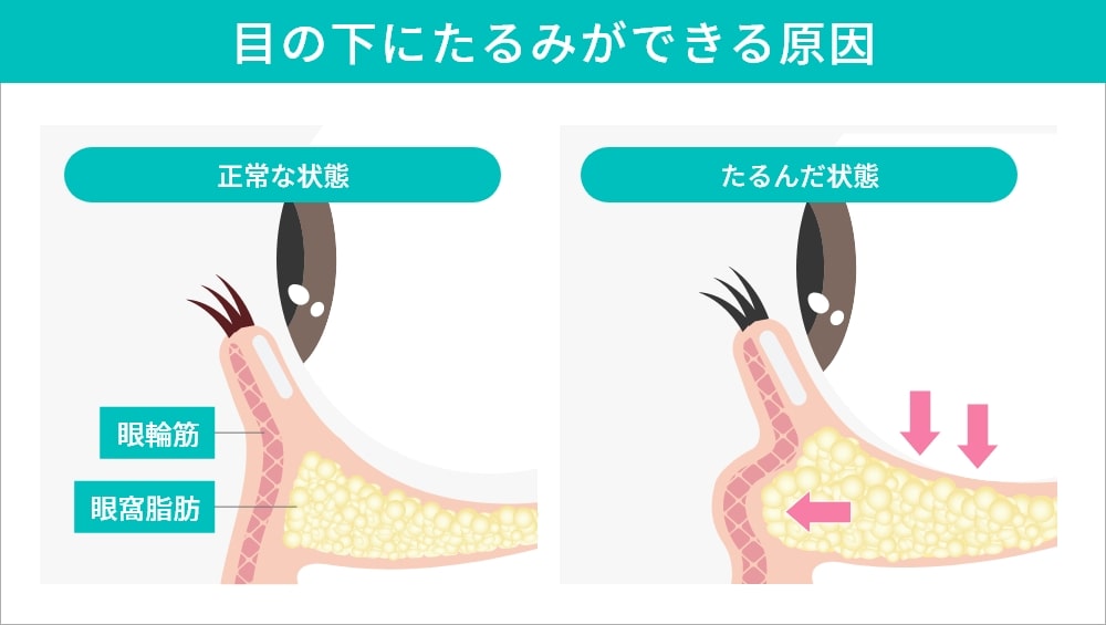 目の下のたるみの原因を解説するイラスト