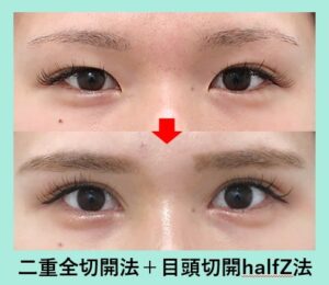 二重全切開+目頭切開（Z法）の症例写真