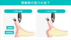 筋力が低下による眼輪筋の違い