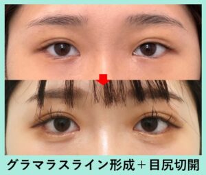 グラマラス形成＋目尻切開の症例写真