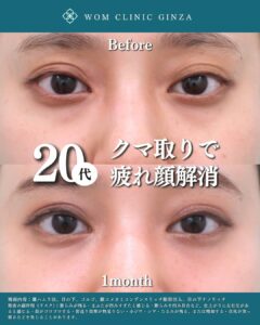 20代　クマ取り治療の症例写真（正面）