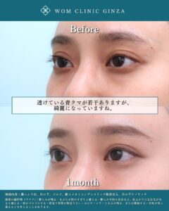 20代　クマ取り治療の症例写真（横）