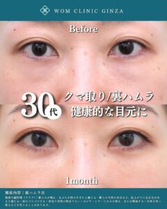 30代　クマ取り治療の症例写真（正面）