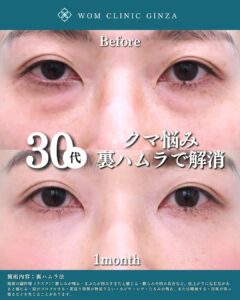 30代　クマ取り治療の症例写真（正面）2