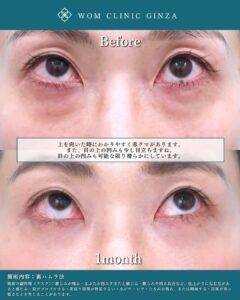 30代　クマ取り治療の症例写真（横）2